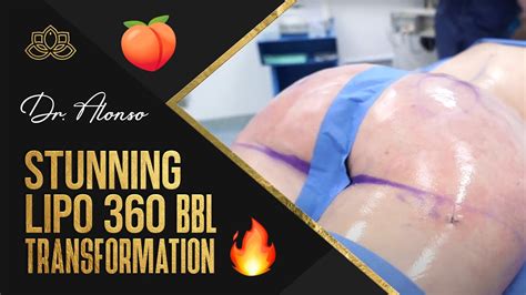 Stunning Lipo 360 Bbl Transformation🤩 By Dr Alonso Vive Plastic