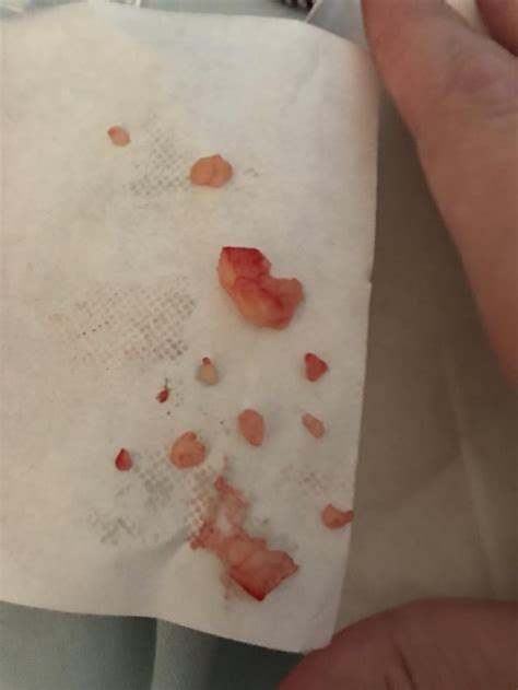 Cyst On My Leg Exploded The Other Day Got All This Out Of It It Ended Up Being 2cm Deep Into