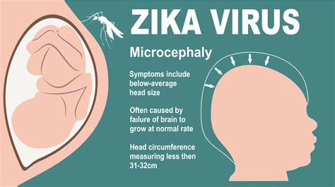 Zika And Pregnancy Symptoms Effects And Prevention