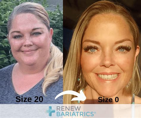 Gastric Sleeve Before And After