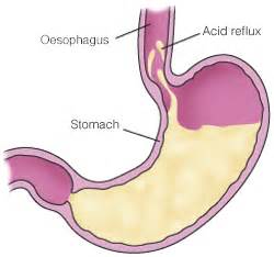 Gastric Acid; Hydrochloric Acid, Gastric