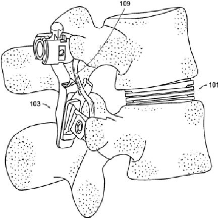 Figure From A Biomechanical Evaluation Of Lumbar Facet Replacement