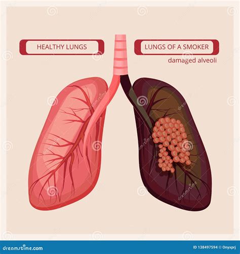 Smoker Lungs. Smoke Human Damage Lung Cancer Vector Medical Infographic ...