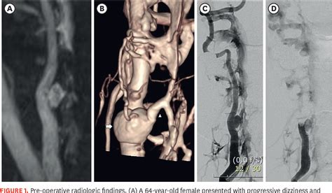 Figure 1 From Stent Assisted Coil Embolization Of A Vertebro Vertebral