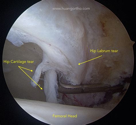 Acetabular Labrum Mri