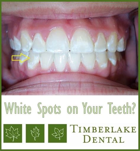 White Spots On Your Teeth Artofit