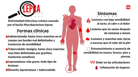 Lepra: tratable y curable - Infomed Santiago