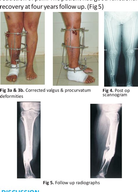 Oblique Plane Deformity Correction With Ilizarov Technique In Case Of