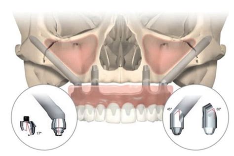 Zygomatic Implants Montreal L Zygomatic Implants Near Me Montreal