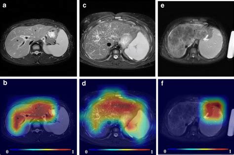 Axial T Weighted Fast Spin Echo Fat Suppressed Liver Mr Images A C