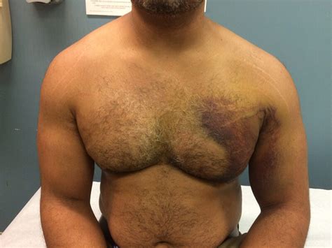 Pec Repair Shoulder Injuries Dr Christopher Ahmad