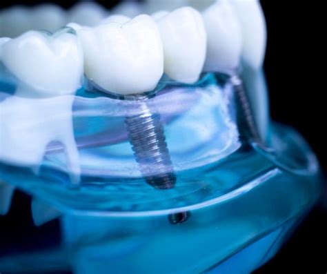 Cómo cuidar los Implantes dentales Sonrisa restaurada