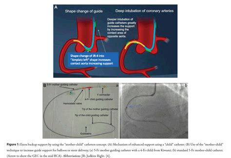 Judkins Left Catheter Uses Deals With | brunofuga.adv.br