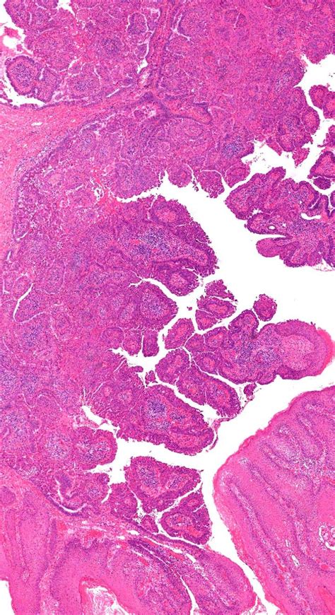 Pathology Of Syringocystadenoma Papilliferum Medical School