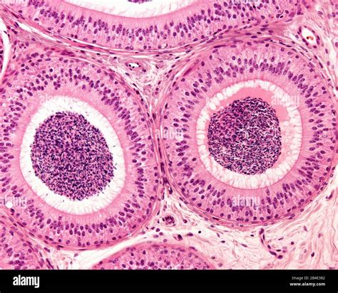 Pseudostratified Columnar Epithelium With Stereocilia