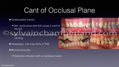 Occlusal Plane Inclination Dr Sylvain Chamberland Orthodontist