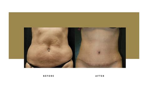 Abdominoplasty Beverly Hills Julie Edween D O