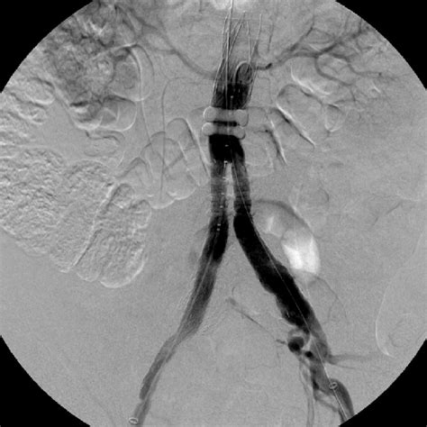 Completion Intra Operative Angiography Showing Good Positioning Of The Download Scientific