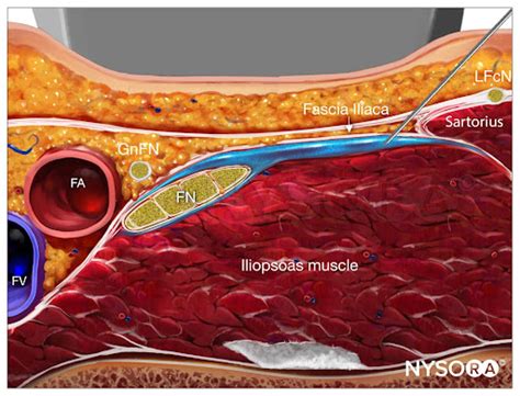 Bloqueo Del Nervio De La Fascia Il Aca Guiado Por Ultrasonido Nysora