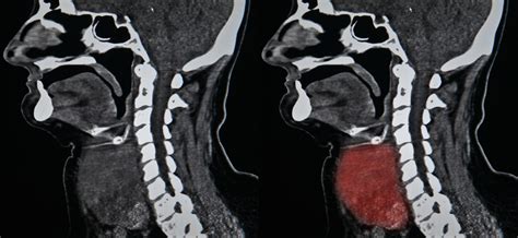 What is a Neck CT scan? | Two Views