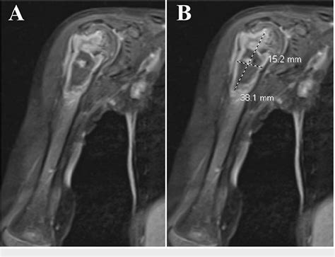 Figure 3 From Tuberculosis Osteomyelitis As An Indolent Bone Mass Semantic Scholar