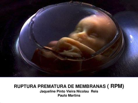 Ruptura Prematura De Membranas RPM Jaqueline Vieira UDocz