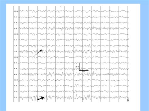 Eeg In Pediatric Dnb Pediatric Ppt