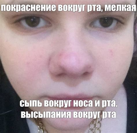 Meme: "покраснение вокруг рта, мелкая сыпь вокруг носа и рта, высыпания ...