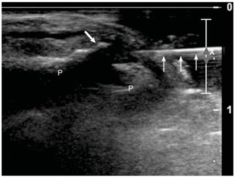 File Interphalangeal Joint Injection Ultrasound Long Axis In Plane  Wikism