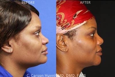 Rhinoplasty Case 1894 Radiance Surgery Aesthetic Medicine