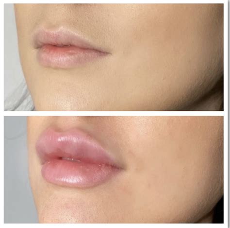 Dermal Filler West End Dermal Filler Brisbane Skin Clique