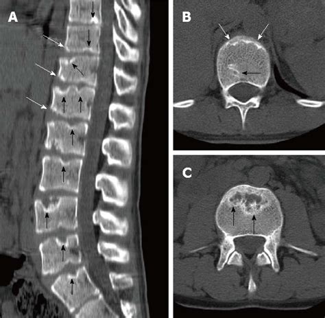 Scheuermanns Disease Radsource