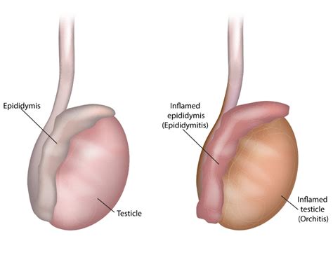 Scrotal Abscess