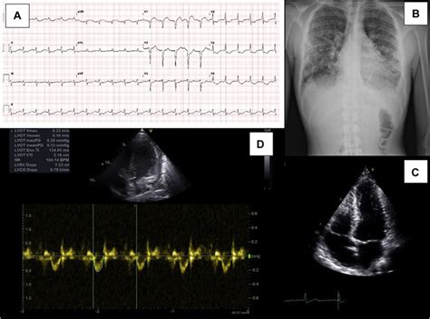 Fulminant Eosinophilic Myocarditis A Rare And Life Threatening