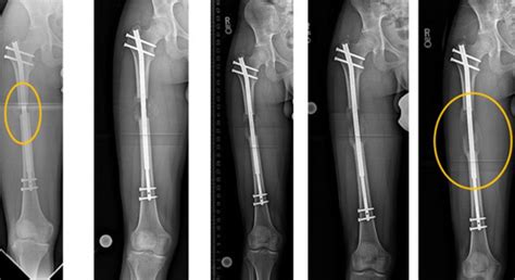 FICANDO MAIS ALTO CIRURGIA promete aumentar ALTURA do paciente em até