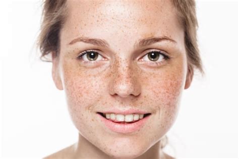 Bintik Wajah Atau Freckles Ini Penyebab Dan Cara Menghilangkannya