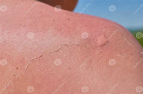 Man S Shoulder With Peeling Skin After Sunburn And A Blister From A