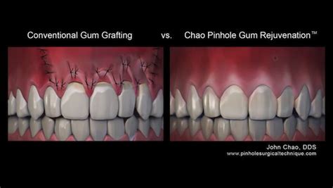 Illustration Showing Conventional Grafting Vs Pinhole Surgical