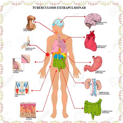 TUBERCULOSIS EXTRAPULMONAR