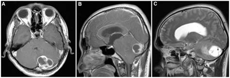 Frontiers Intraparenchymal Cerebellar Capillary Hemangioma In A 32