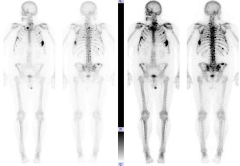 Prostate cancer bone metastases - 6 months after first meta : Radiology