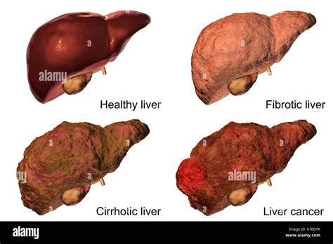 La Fibrosis Hepática Es Una Hígado Sano Vida Sana Facebook