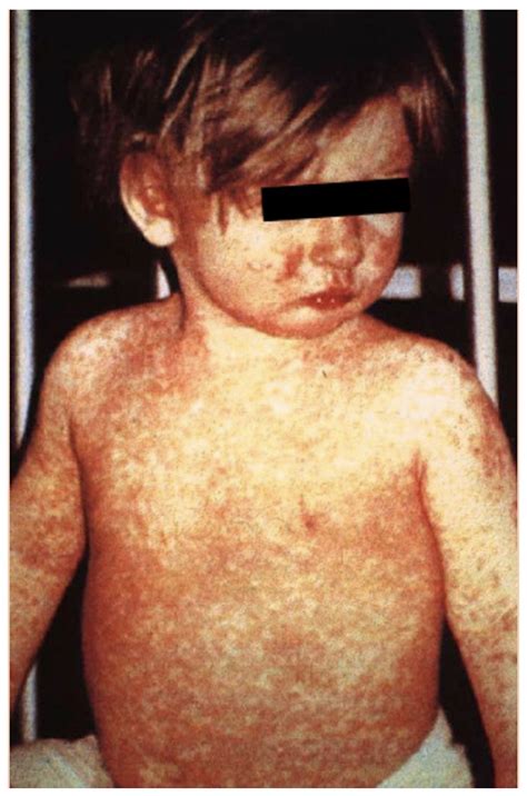 Diagnosing Measles In The Post Elimination Era