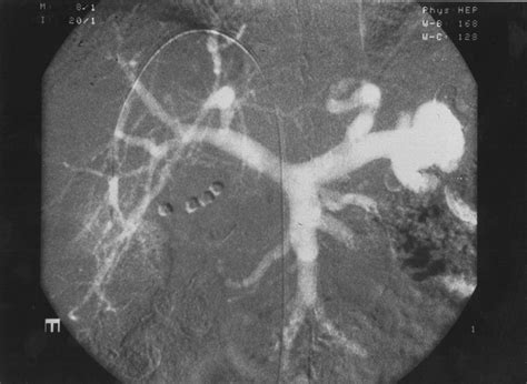 Co2 Wedged Hepatic Venography In The Evaluation Of Portal Hypertension