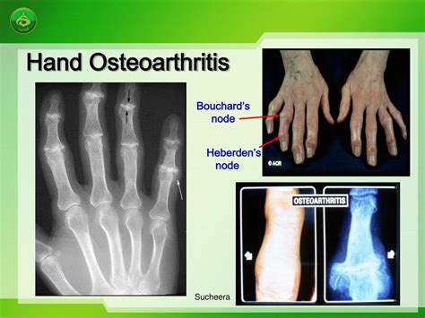 PPT - Osteoarthritis and exercise PowerPoint Presentation, free