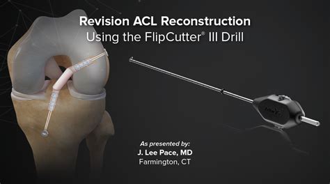 Arthrex Revision ACL Reconstruction Using The FlipCutter III Drill