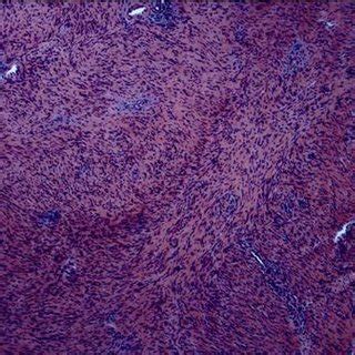 Low Power Photomicrograph 40 Demonstrating A Cellular Schwannoma