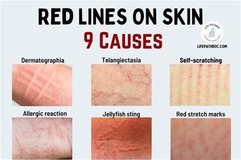 Red Lines On The Skin 9 Causes Pictures And Treatment