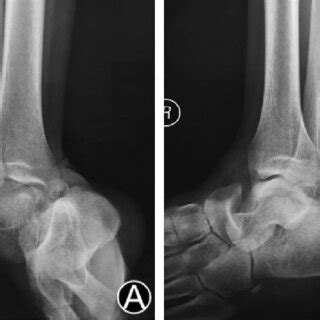 Mri Of Ankle Joint Showed Ankle Joint Effusion Marrow Edema In The