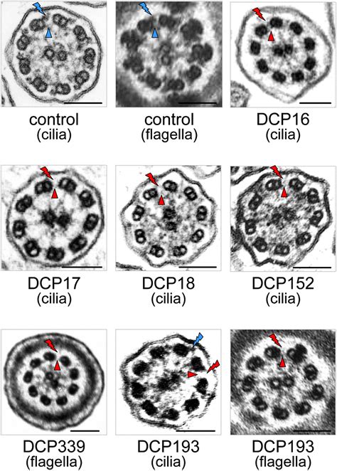 Loss Of Function Mutations In LRRC6 A Gene Essential For Proper